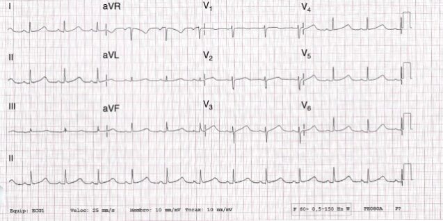 O sobrediagnóstico da síndrome do QT logo persiste sobrediagnóstico da Síndrome do QT Longo (SQTL), uma condição cardíaca que pode causar arritmias perigosas e morte súbita.