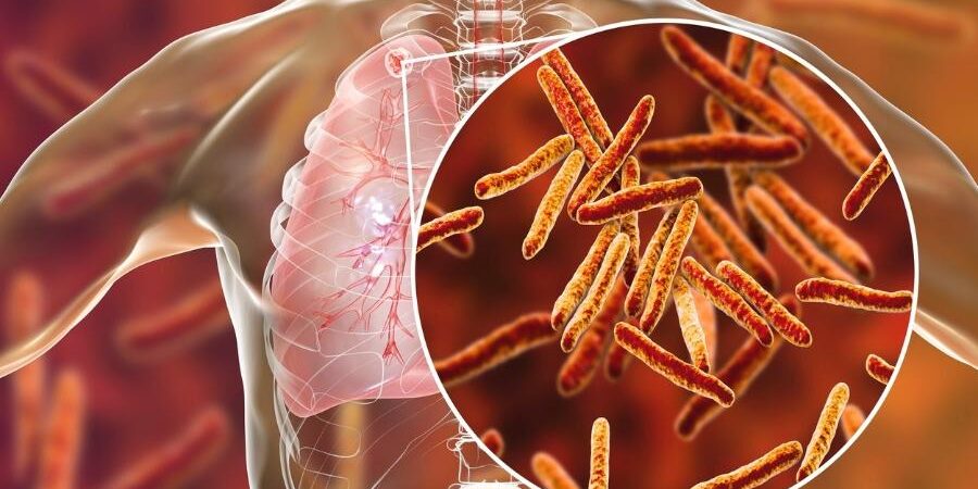 tuberculose-bacilo-de-koch